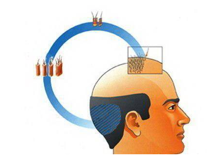 头发如何种植？