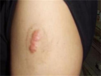 手术疤痕怎么去除啊?