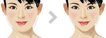 脸部抽脂需要多少钱