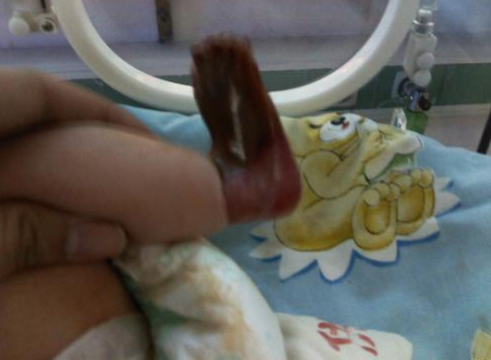 河南婴儿刚出生就被诊断为火棉胶,究竟什么是火棉胶婴儿?