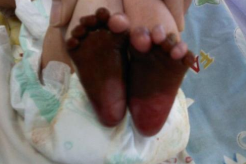 河南婴儿刚出生就被诊断为火棉胶,究竟什么是火棉胶婴儿?