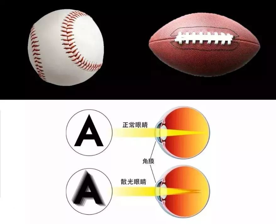 儿童眼睛散光是怎么回事?