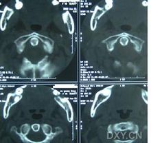 先天性肌性斜颈最有效的疗法是什么？