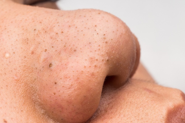 怎样祛黑头粉刺?