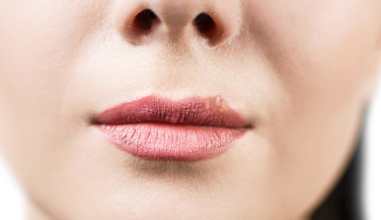 女生唇毛太多怎么办?