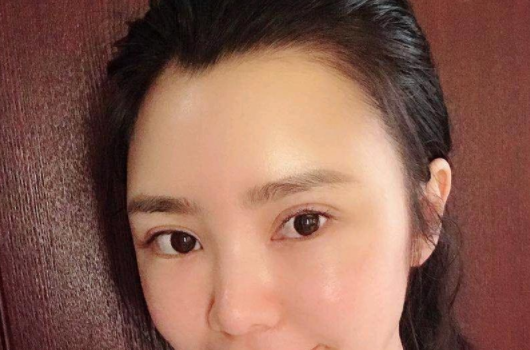 如何去除法令纹?