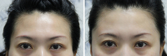 太阳穴填充好吗