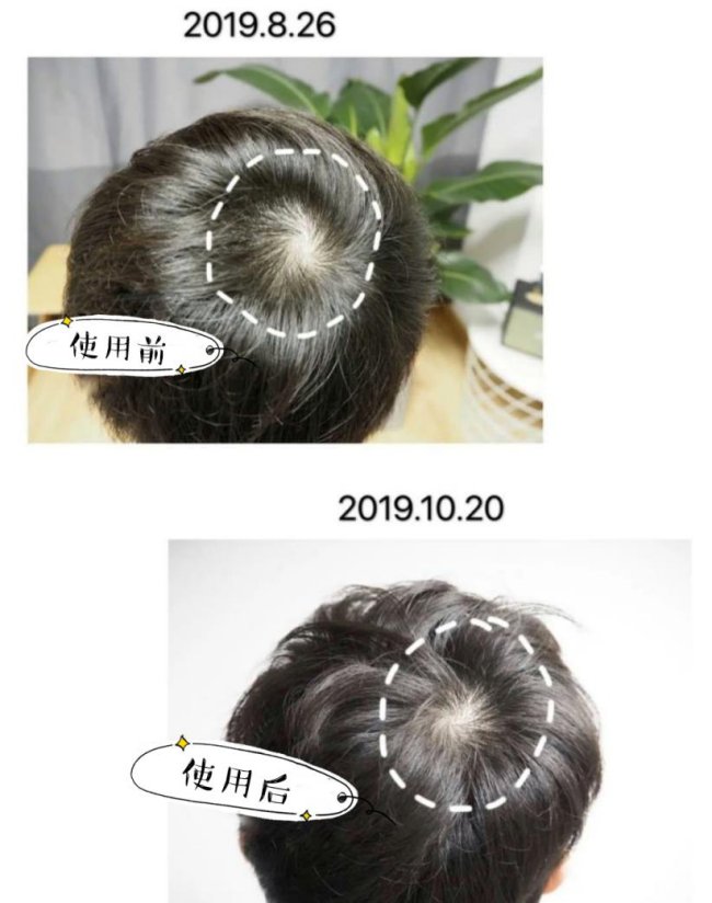 治疗掉头发哪里好