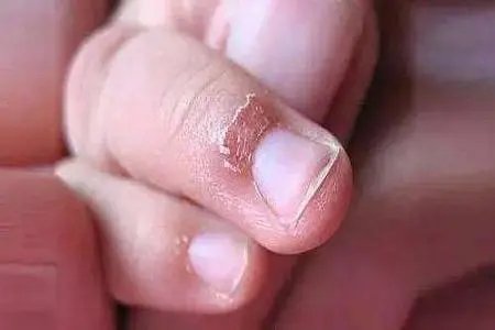 指甲周围长倒刺是缺乏维生素的表现吗？
