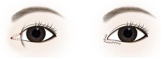 内眼角修复哪好些？