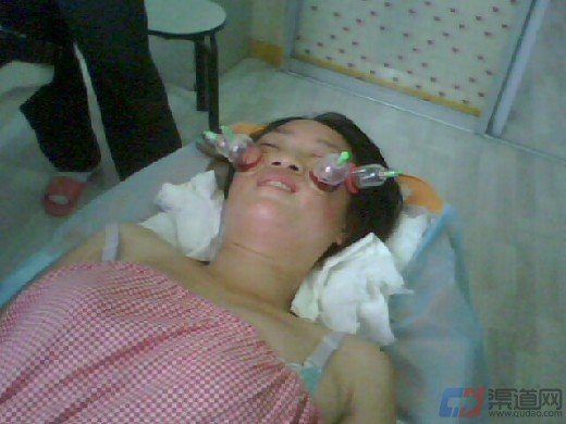 泻血疗法的泻血概要