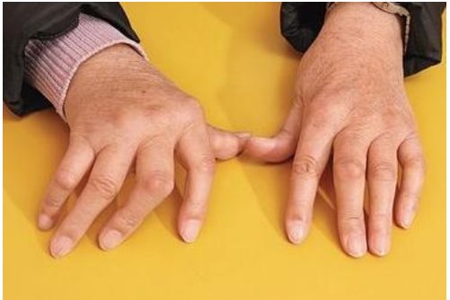 “翼状肩”“方肩”“猿手”“爪形手”“垂腕”征“勾状症”“马蹄内翻足”分别是什么神经损失所致？